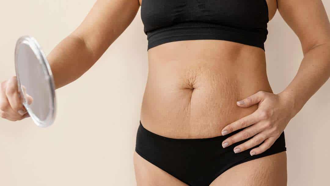 Diástase Abdominal